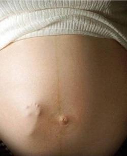 Strip auf Bauch während der Schwangerschaft: warum es erscheint und wo es nach der Geburt verschwindet