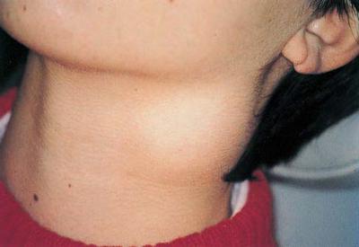 Der Lymphknoten am Hals von Kindern ist vergrößert. Was sagt es?