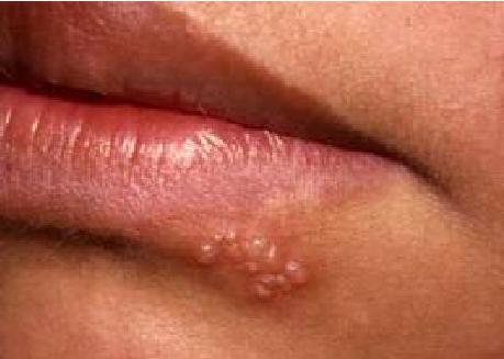 wie man Herpes auf den Lippen schnell kuriert