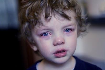 Rote Augen bei einem Kind: Ursachen, Behandlung und Vorbeugung