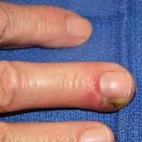 Auf dem Finger des Panaritiums. Behandlung zu Hause ist möglich?