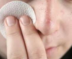 Die Ursachen von Akne im Gesicht und wie man sie los wird