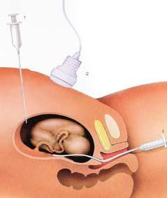 Ultraschall-Screening-Studie. Screening-Test für die Schwangerschaft
